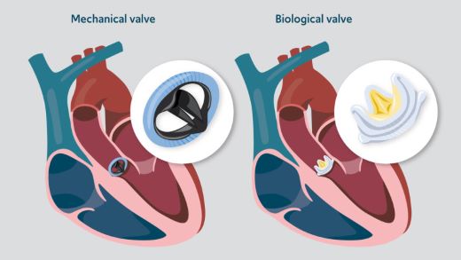 Top 11 Aortic Valve Replacement Companies in the World
